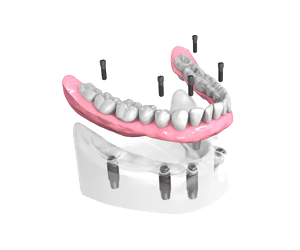 Implants dentaires Marseille - Cabinet dentaire Drs Damiani et Richelme - Dentiste Marseille