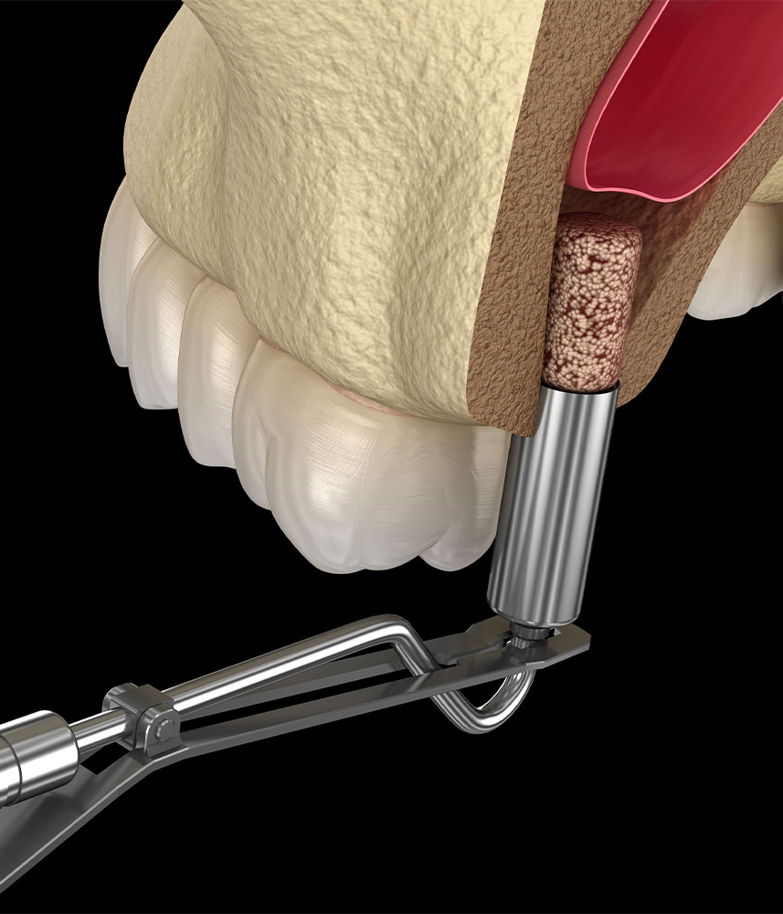 Sinus Lift Marseille - Cabinet dentaire Drs Damiani et Richelme - Dentiste Marseille